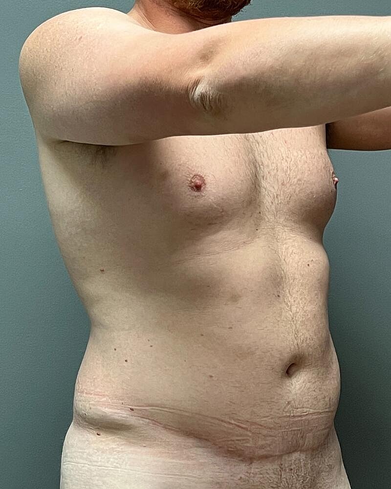 Liposuction Midsection Before & After