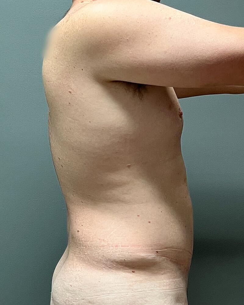 Liposuction Midsection Before & After