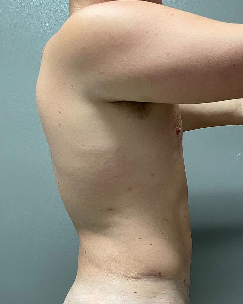 Liposuction Midsection Before & After