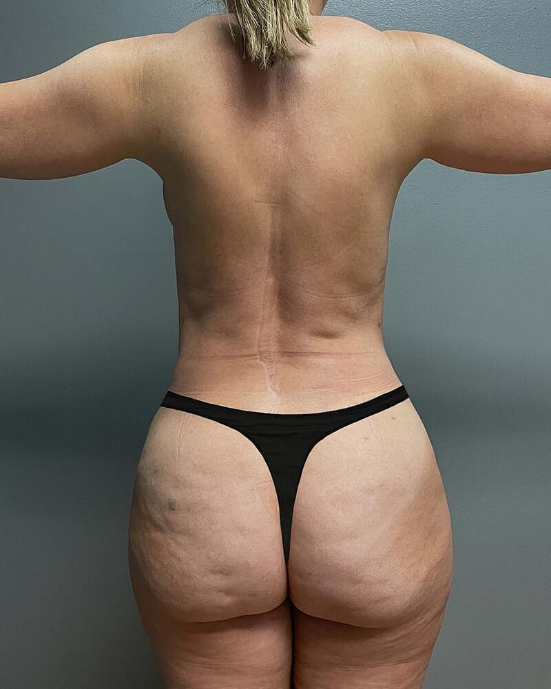 Liposuction Midsection Before & After