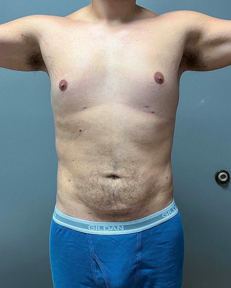 Liposuction Midsection Before & After