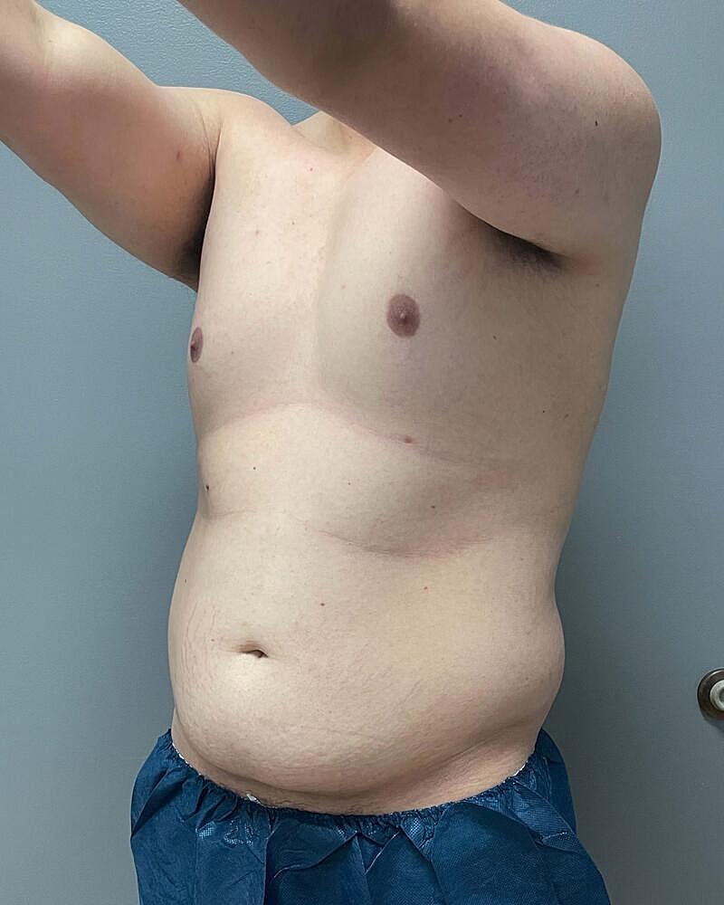 Liposuction Midsection Before & After