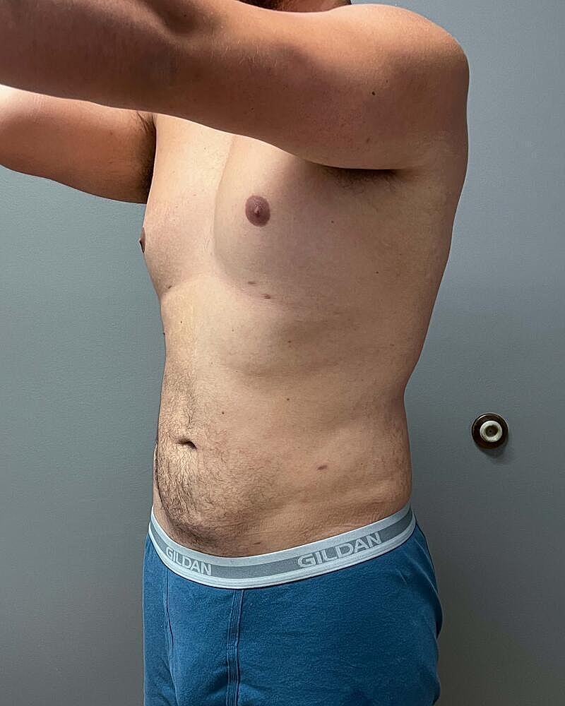 Liposuction Midsection Before & After