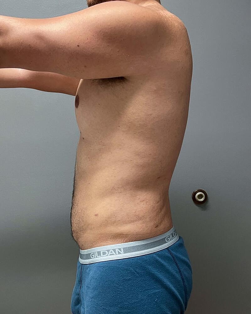 Liposuction Midsection Before & After