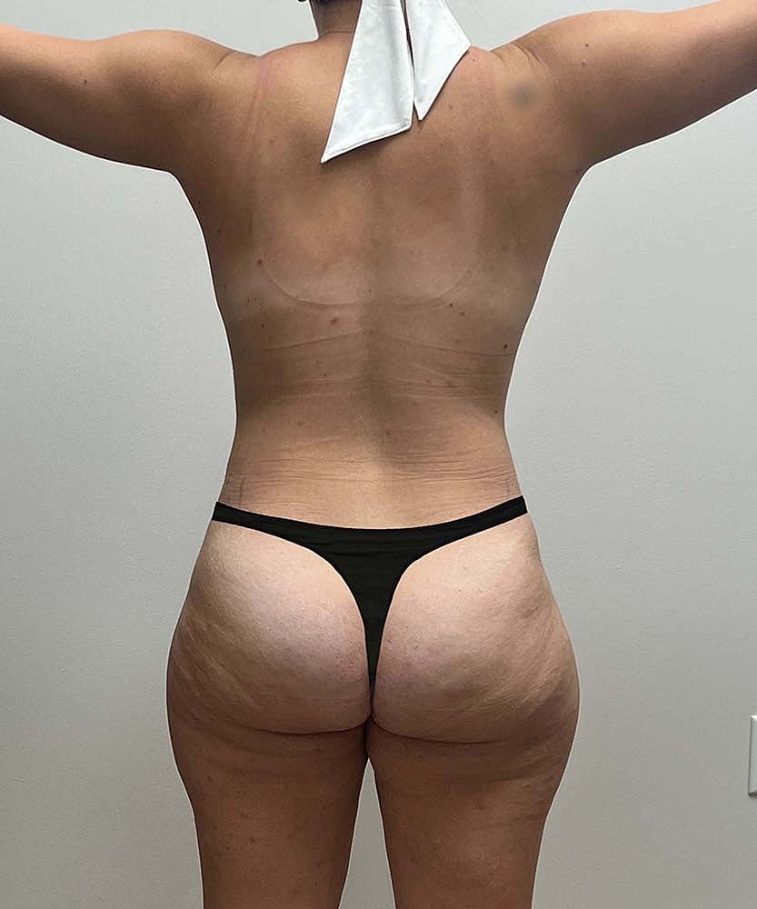 Liposuction Midsection Before & After