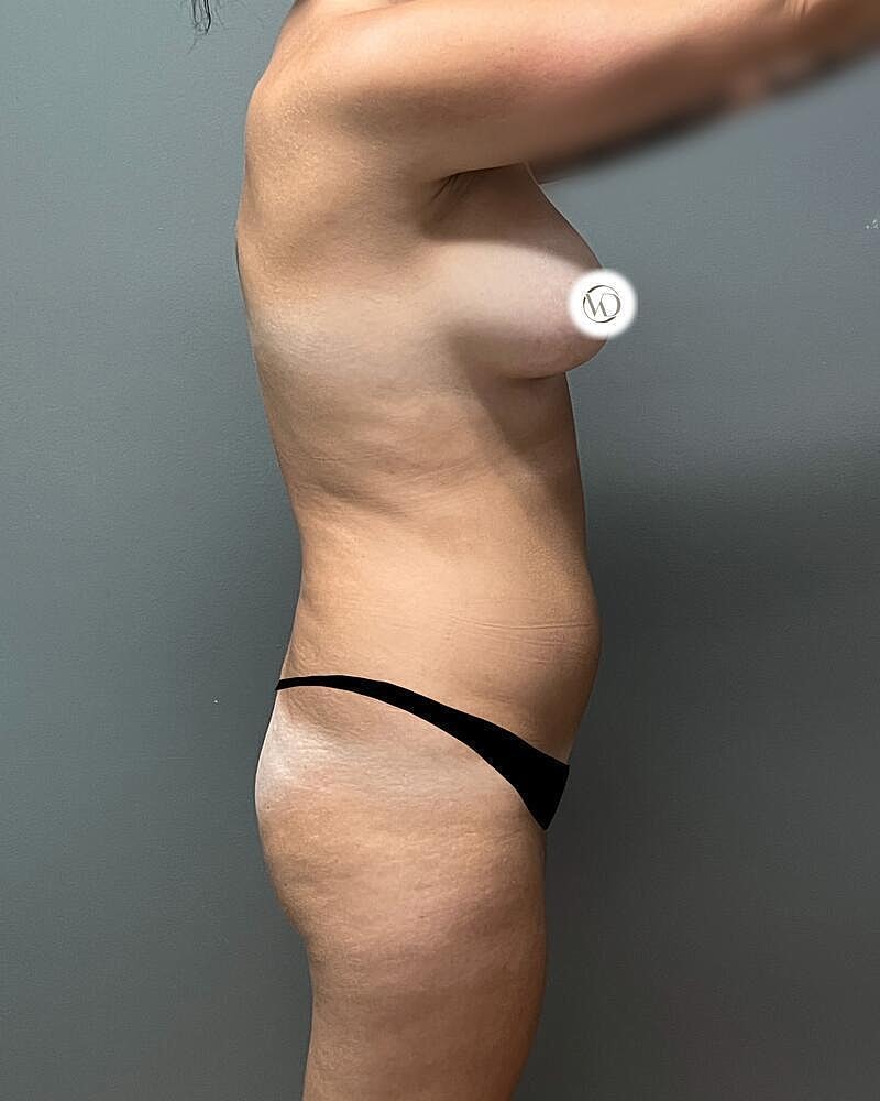 Liposuction Midsection Before & After