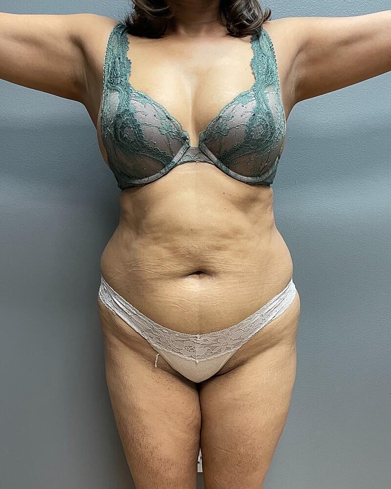 Liposuction Midsection Before & After