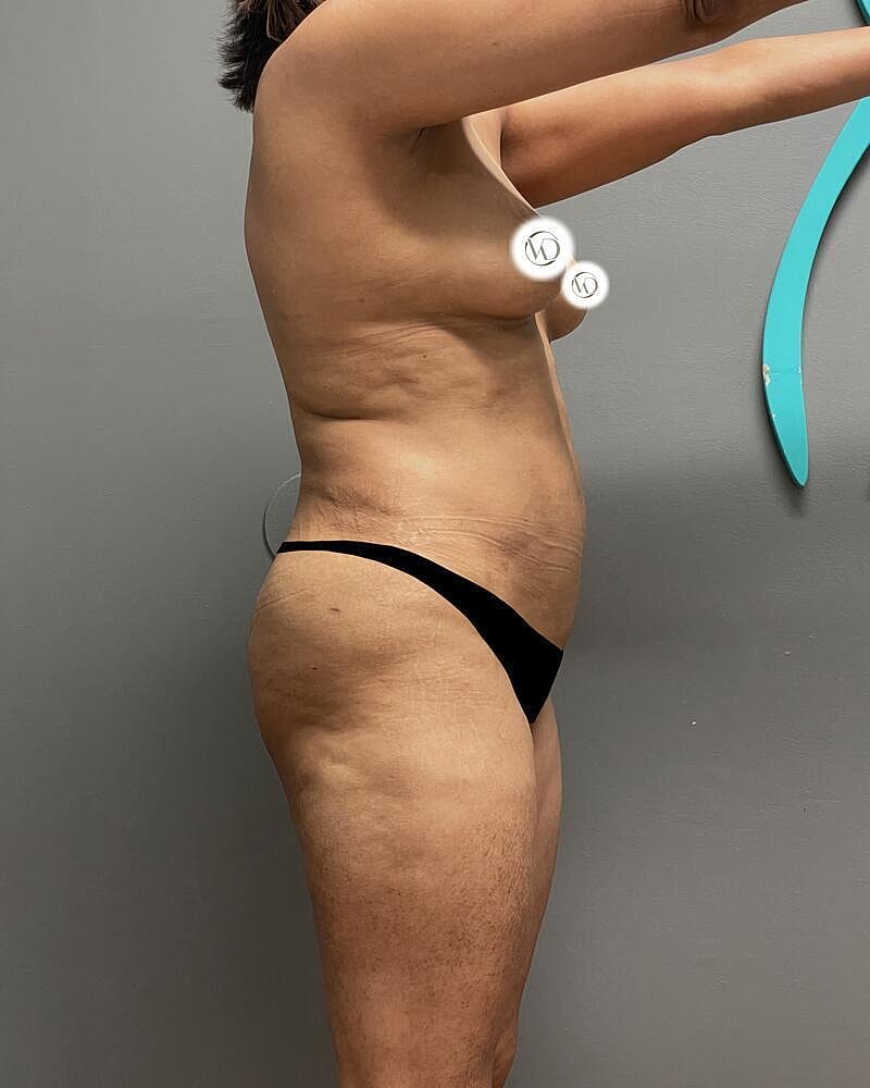 Liposuction Midsection Before & After