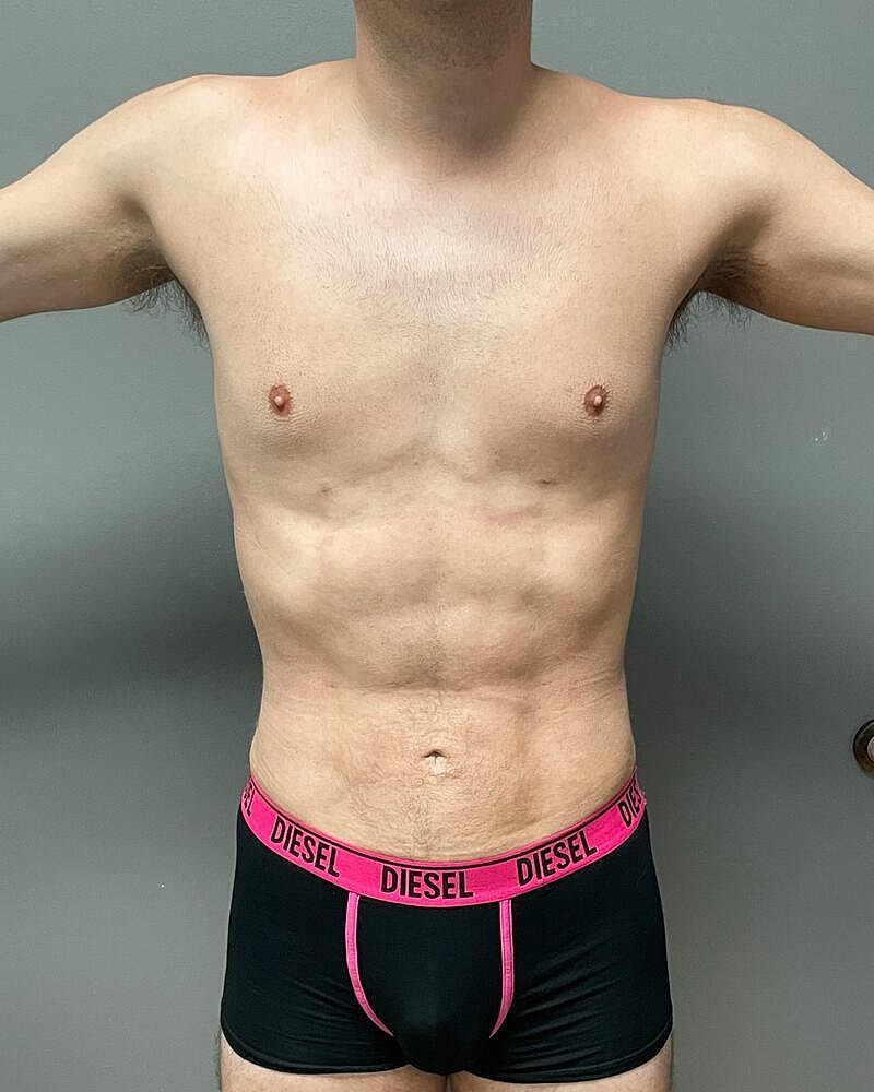Liposuction Midsection Before & After