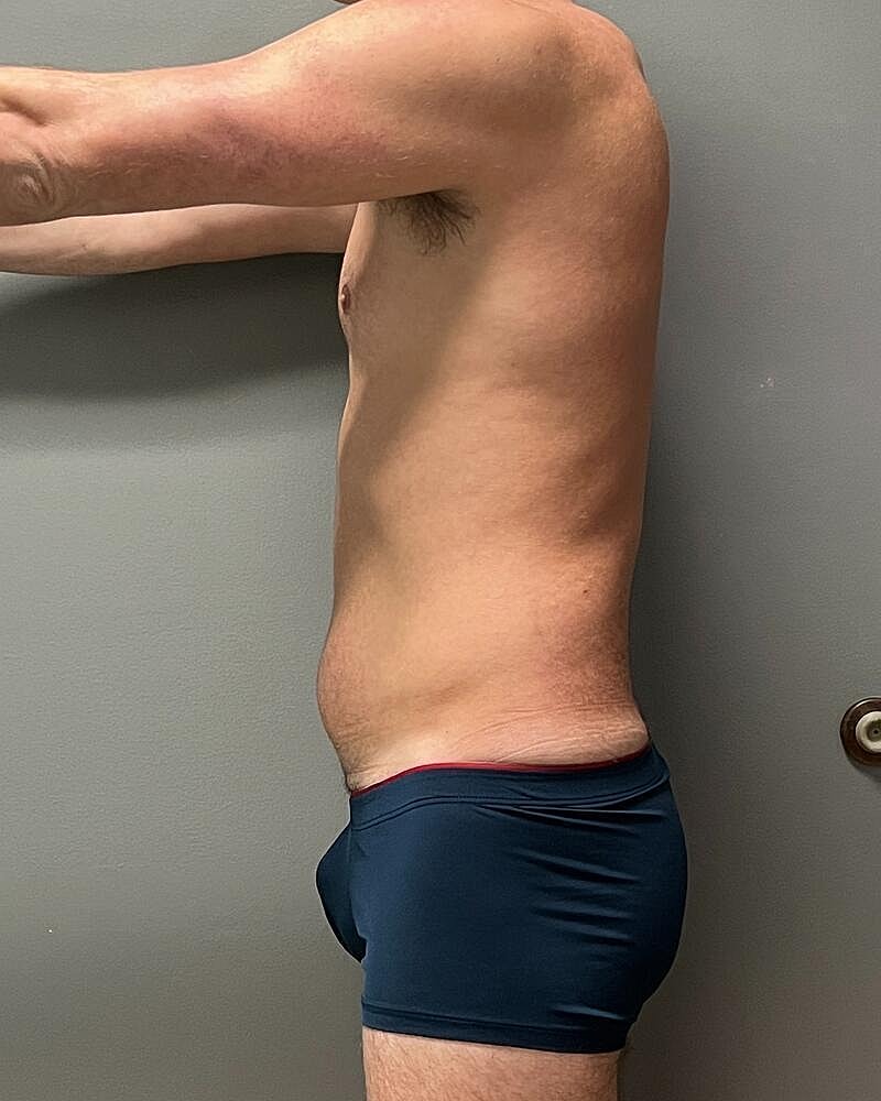 Liposuction Midsection Before & After