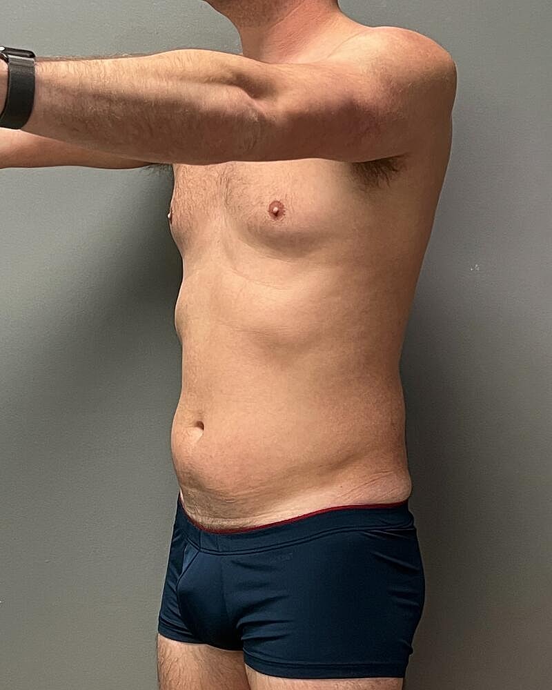 Liposuction Midsection Before & After