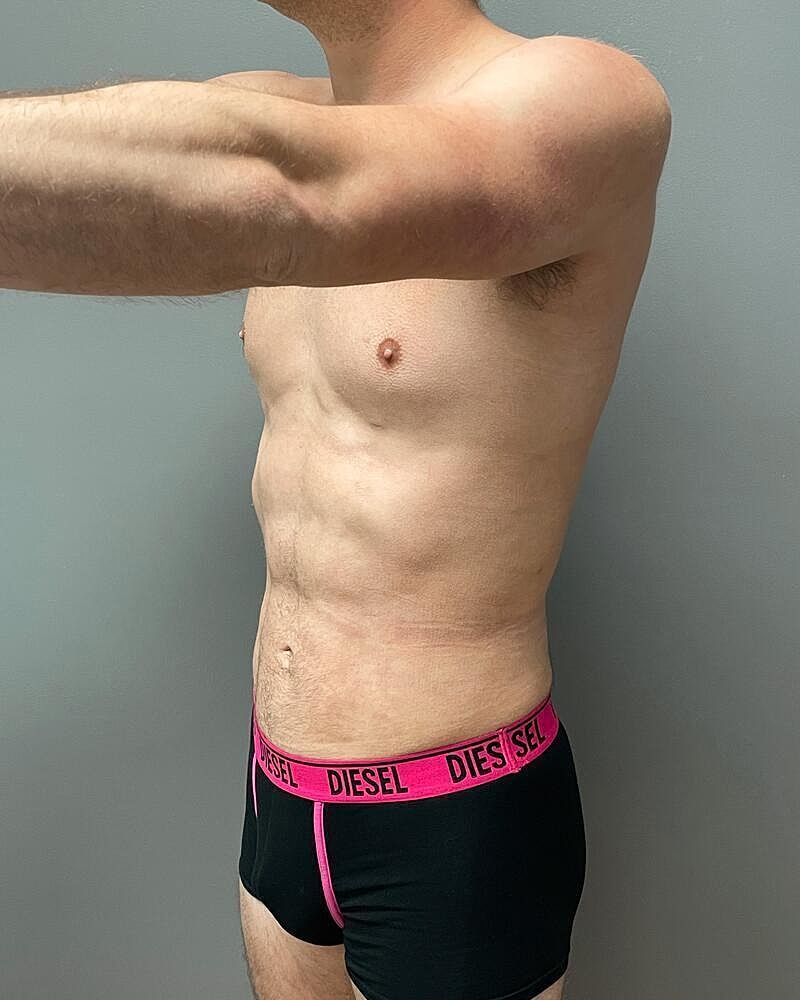 Liposuction Midsection Before & After