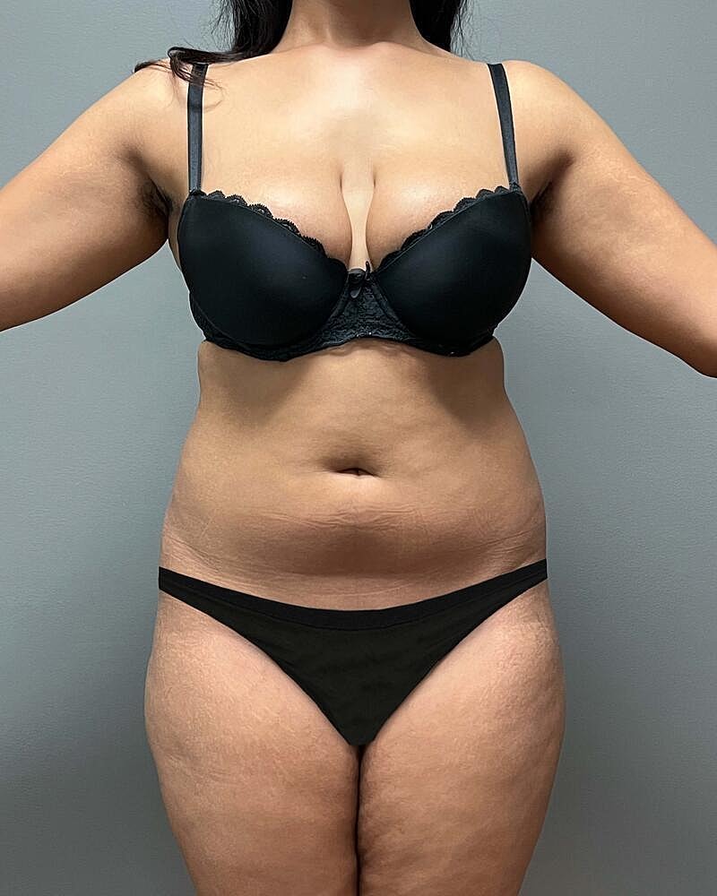 Liposuction Midsection Before & After