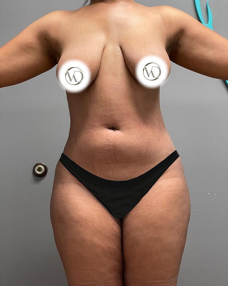 Liposuction Midsection Before & After