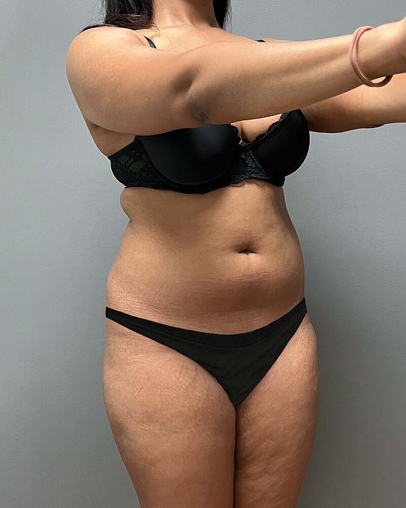 Liposuction Midsection Before & After