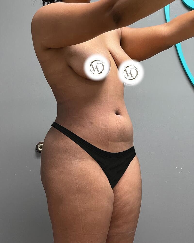 Liposuction Midsection Before & After