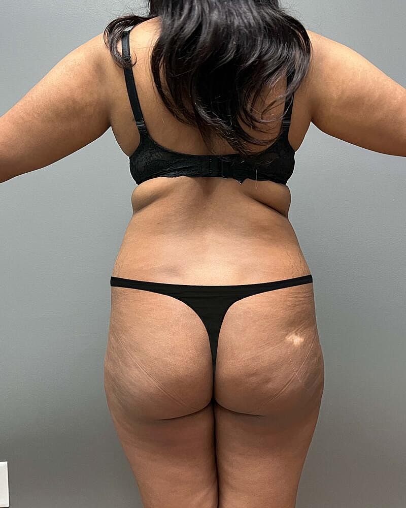 Liposuction Midsection Before & After