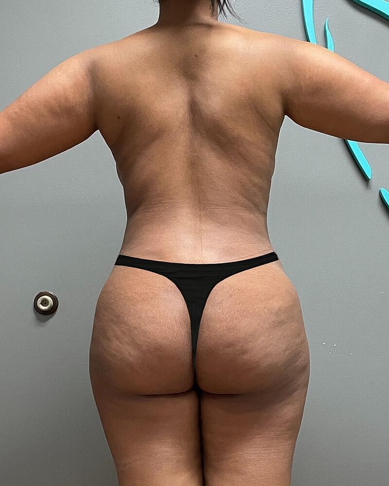 Liposuction Midsection Before & After