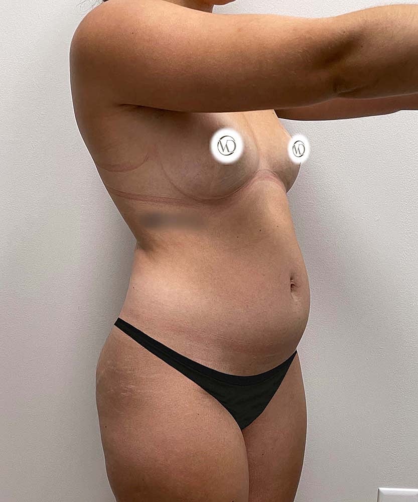 Liposuction Midsection Before & After