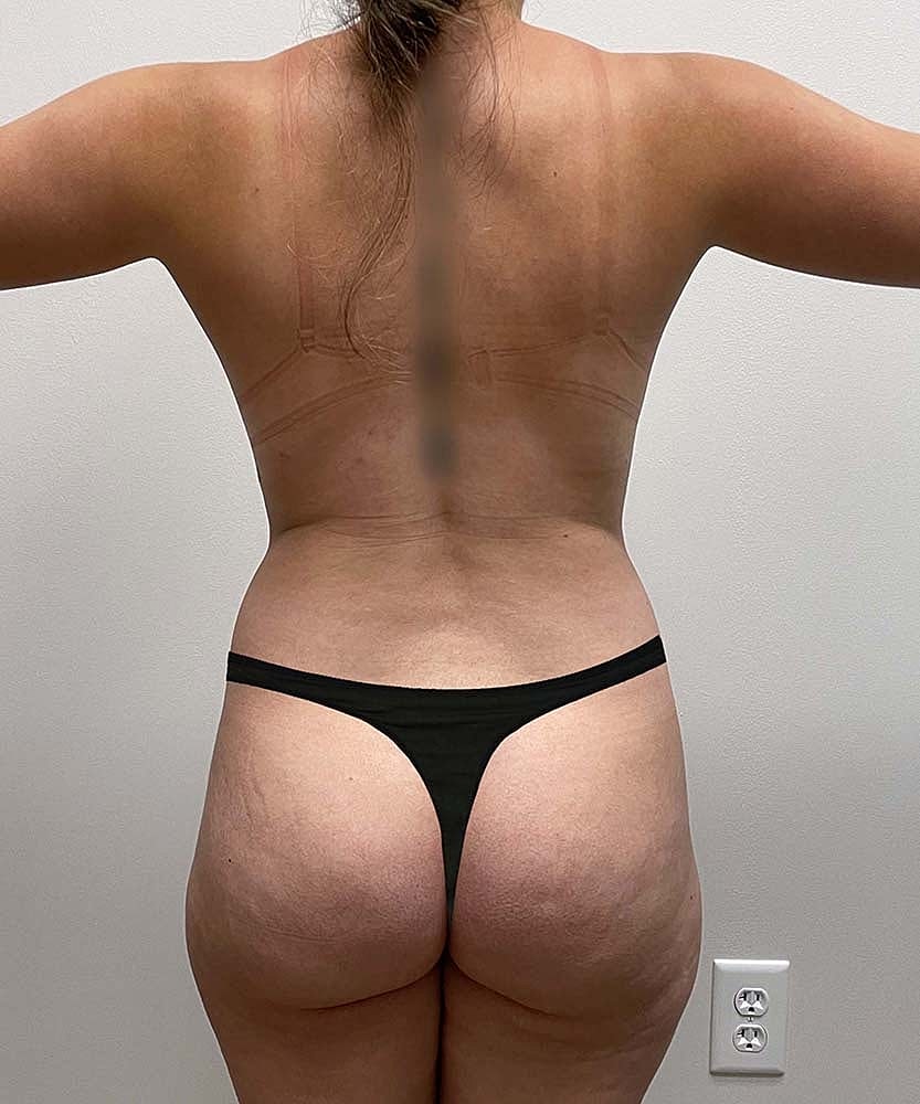 Liposuction Midsection Before & After
