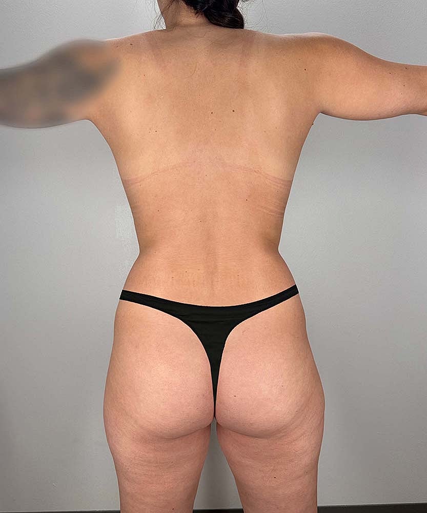 Liposuction Midsection Before & After