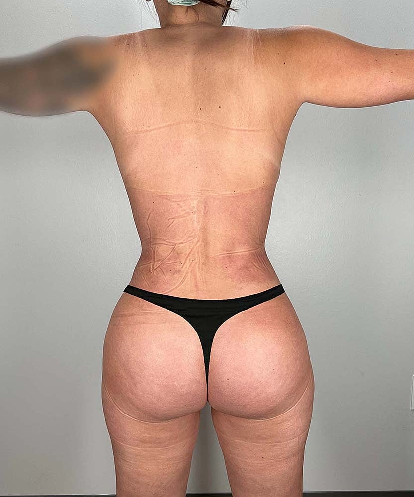 Liposuction Midsection Before & After