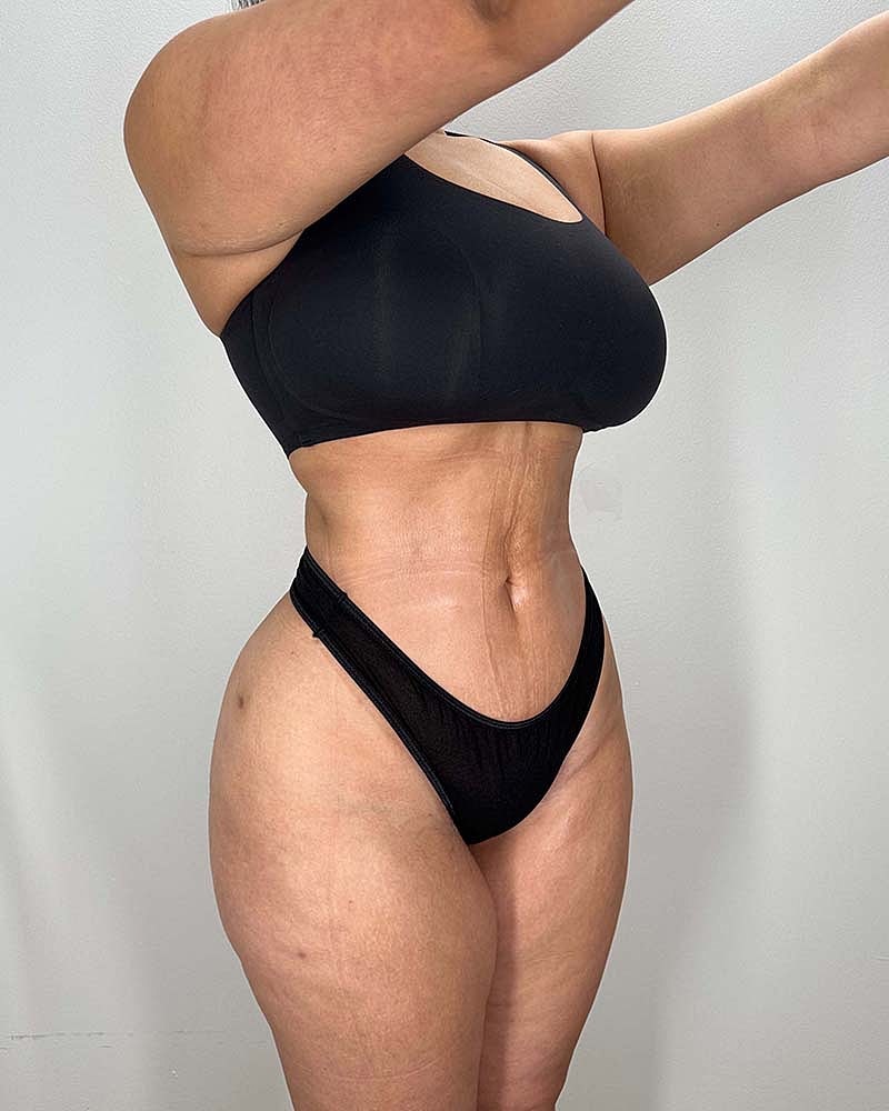 Liposuction Midsection Before & After