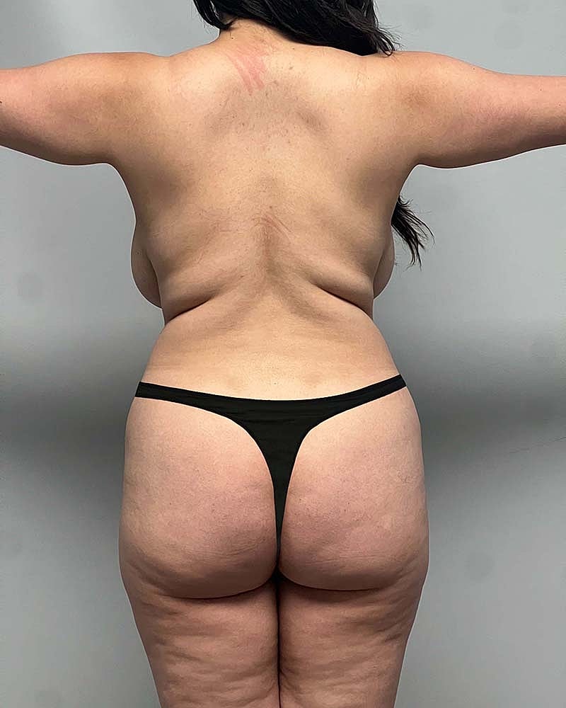 Liposuction Midsection Before & After