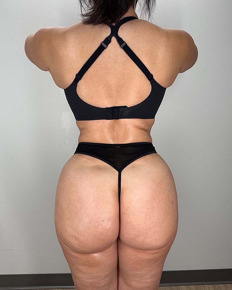Liposuction Midsection Before & After