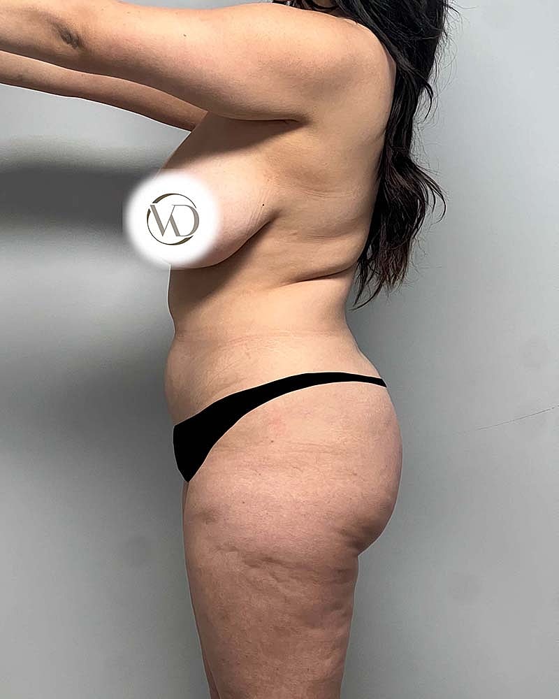 Liposuction Midsection Before & After