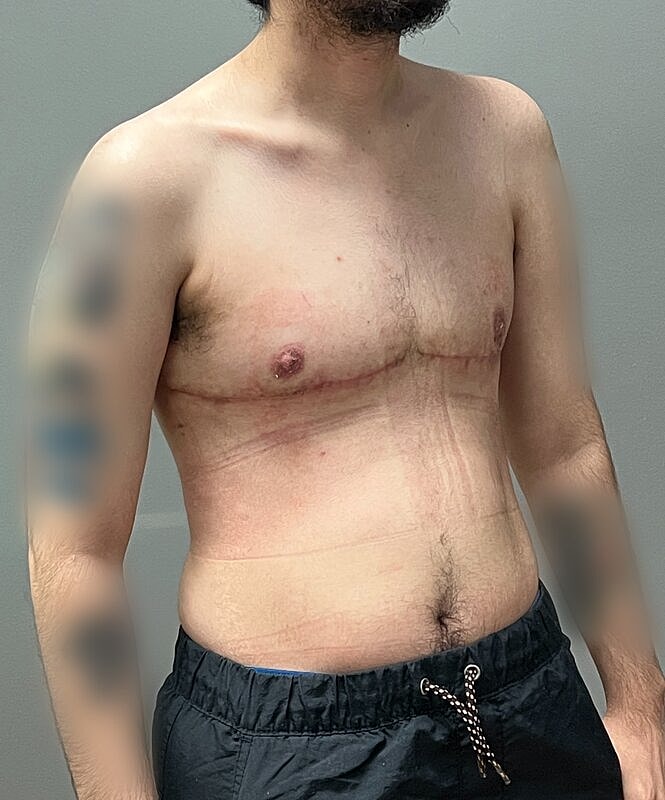 Ftm Top Surgery Before & After