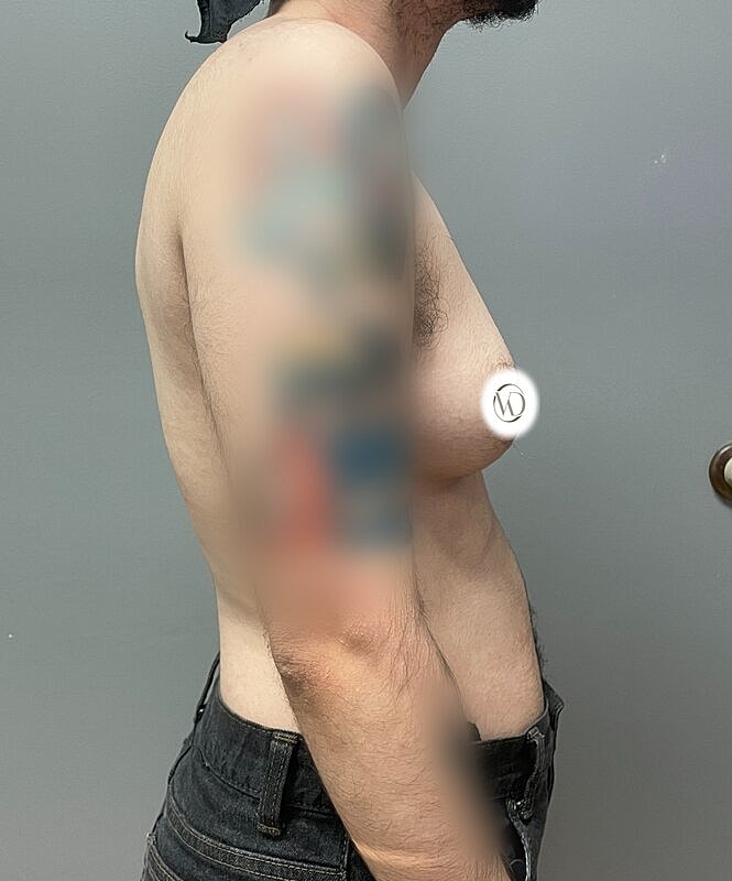 Ftm Top Surgery Before & After