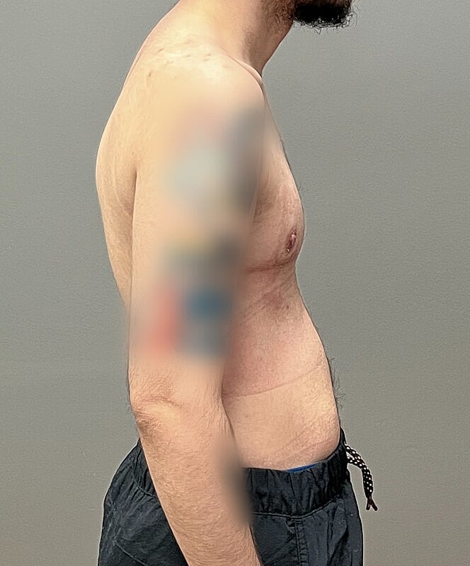 Ftm Top Surgery Before & After