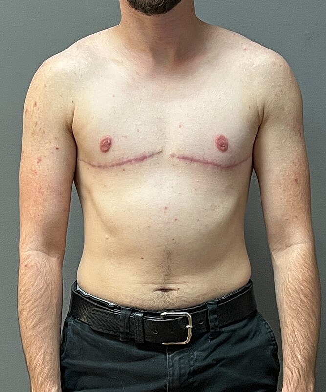 Ftm Top Surgery Before & After