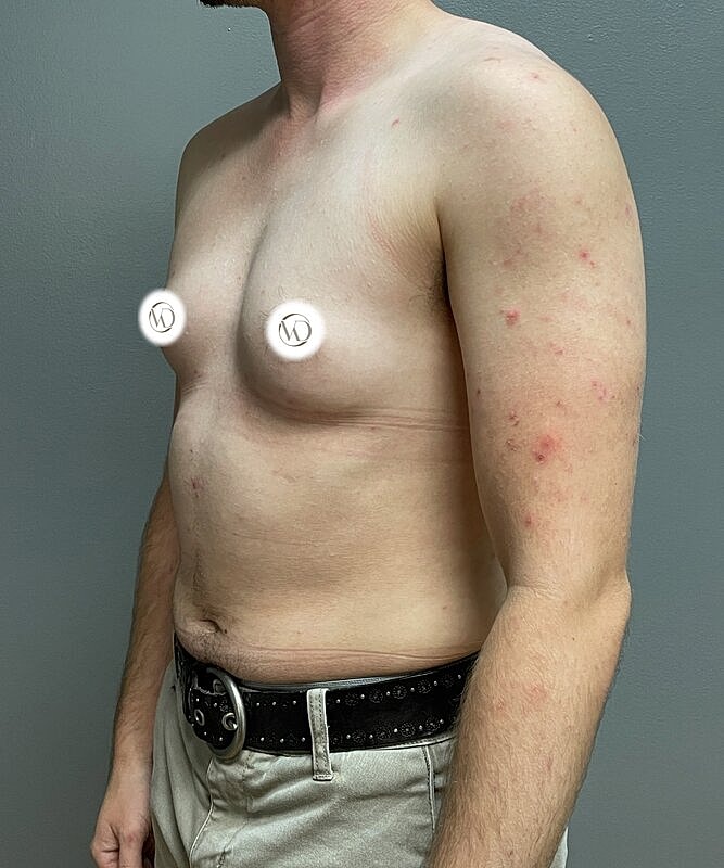 Ftm Top Surgery Before & After