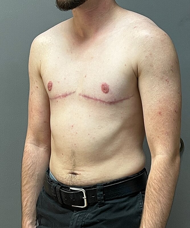 Ftm Top Surgery Before & After