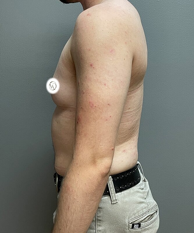 Ftm Top Surgery Before & After