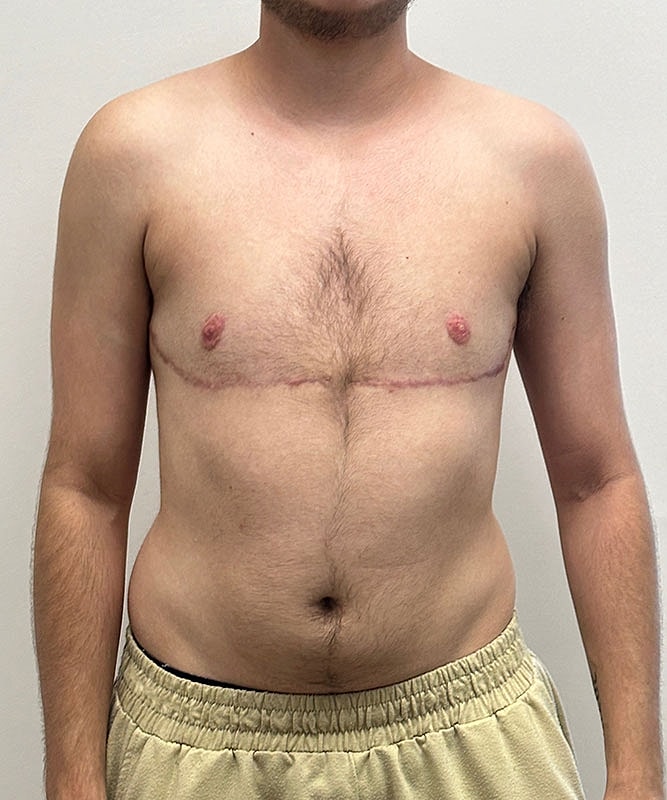Ftm Top Surgery Before & After