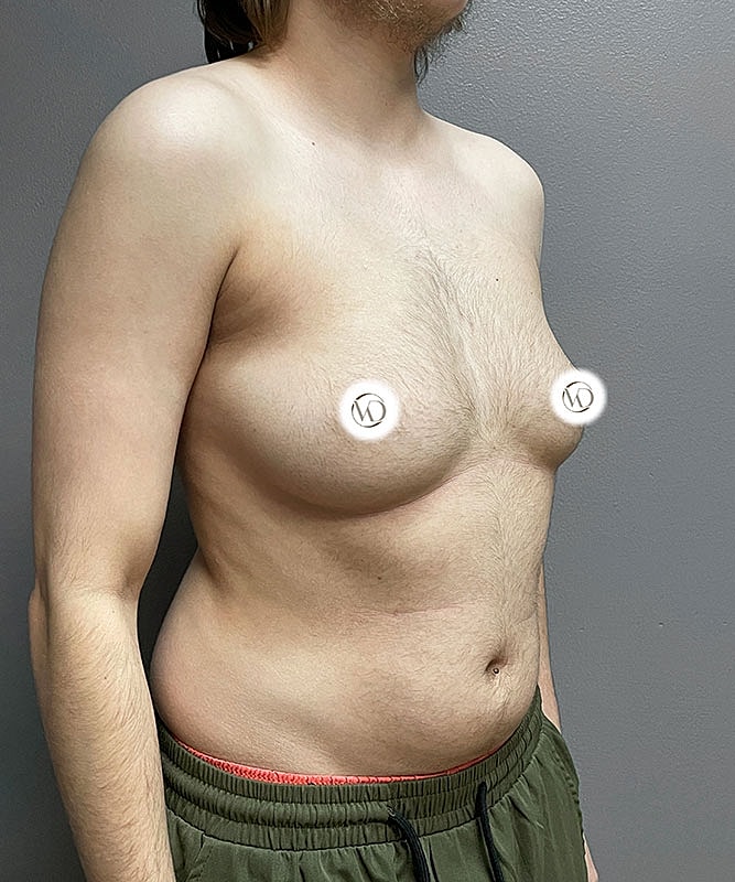 Ftm Top Surgery Before & After