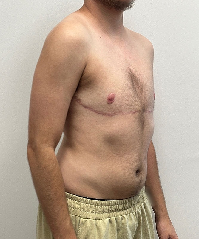 Ftm Top Surgery Before & After
