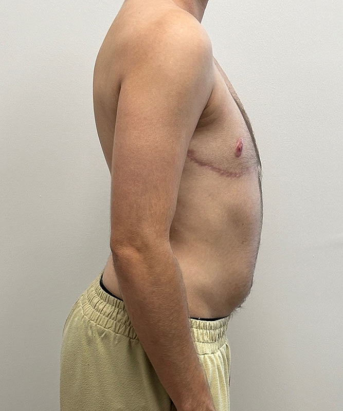 Ftm Top Surgery Before & After