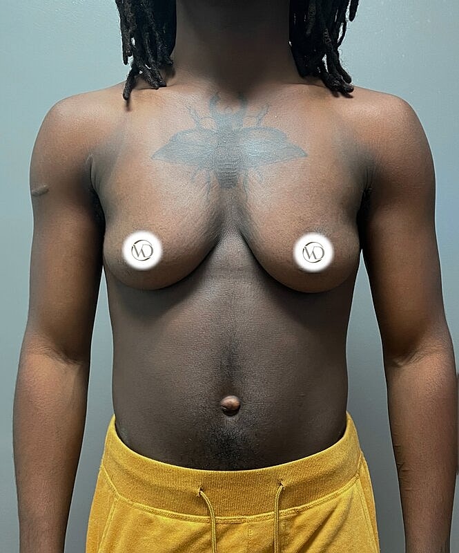 Ftm Top Surgery Before & After