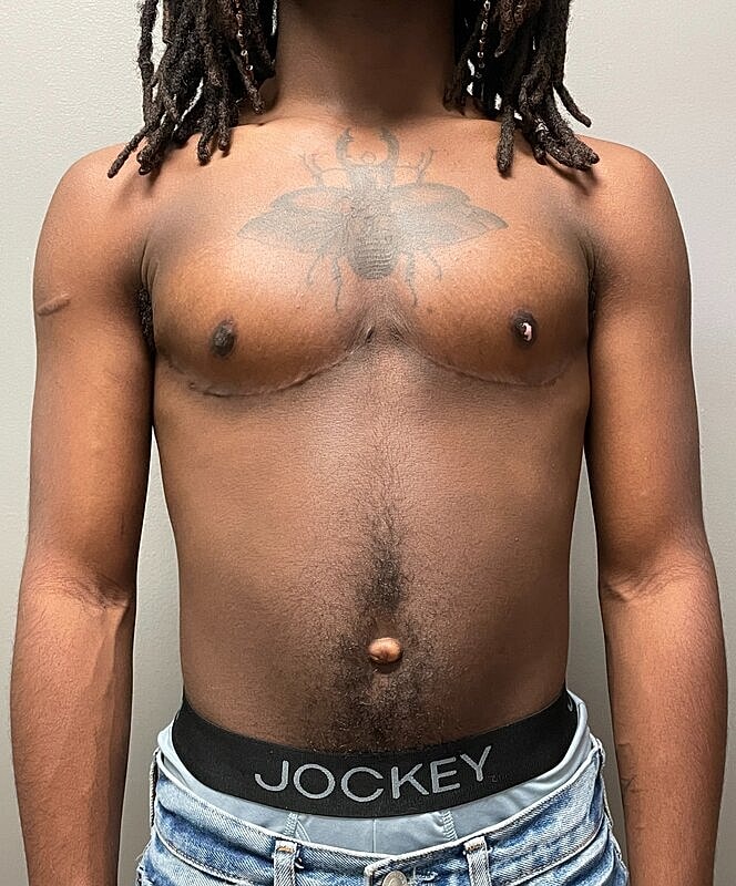Ftm Top Surgery Before & After
