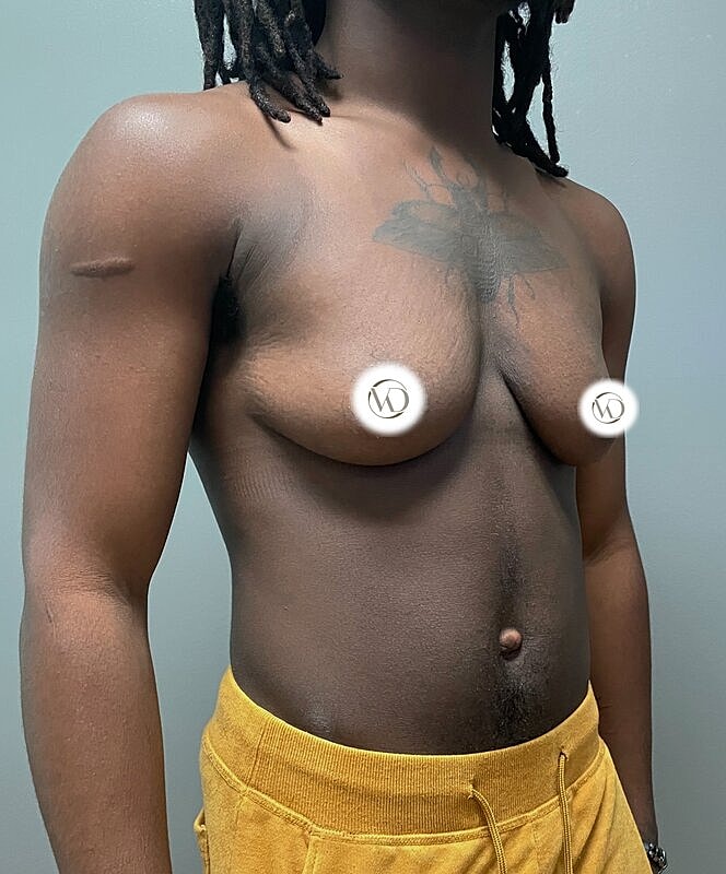 Ftm Top Surgery Before & After