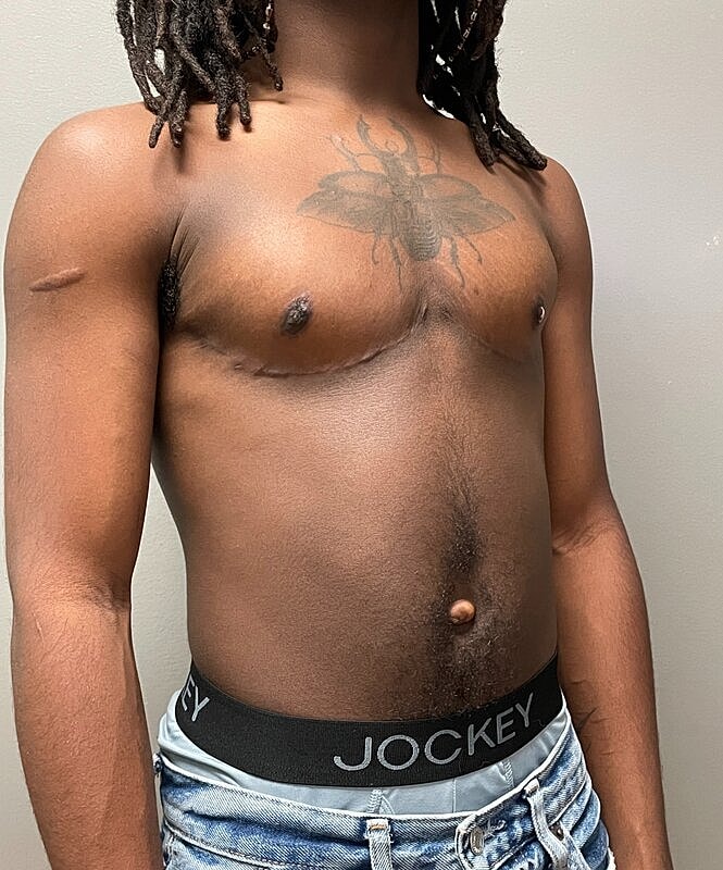 Ftm Top Surgery Before & After