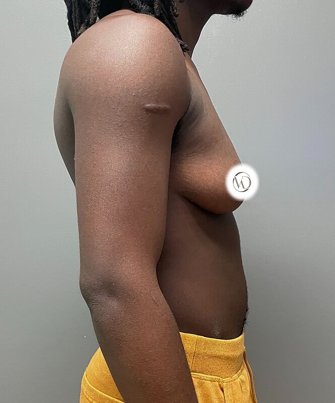 Ftm Top Surgery Before & After