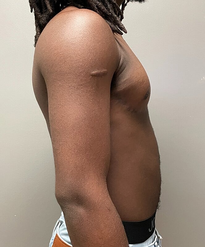 Ftm Top Surgery Before & After