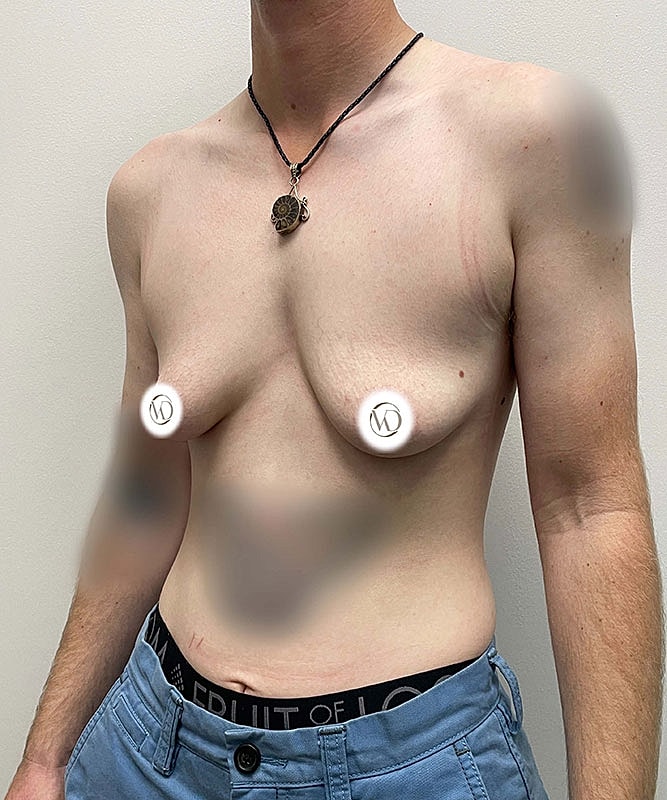 Ftm Top Surgery Before & After