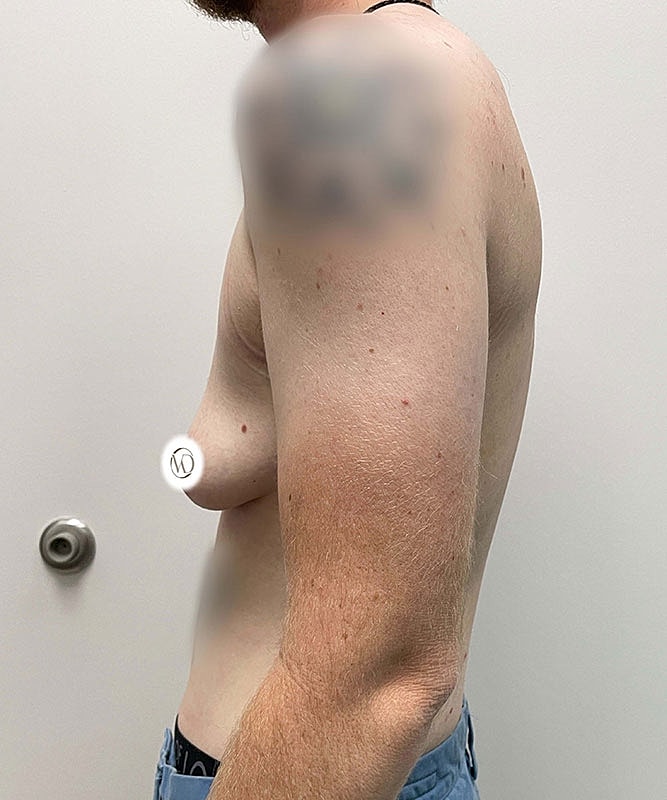 Ftm Top Surgery Before & After