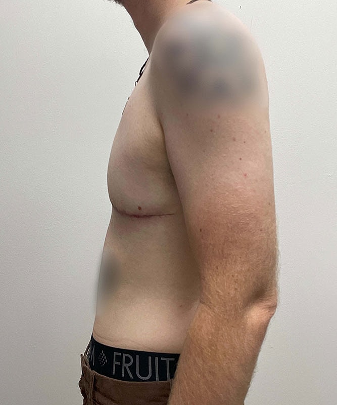 Ftm Top Surgery Before & After